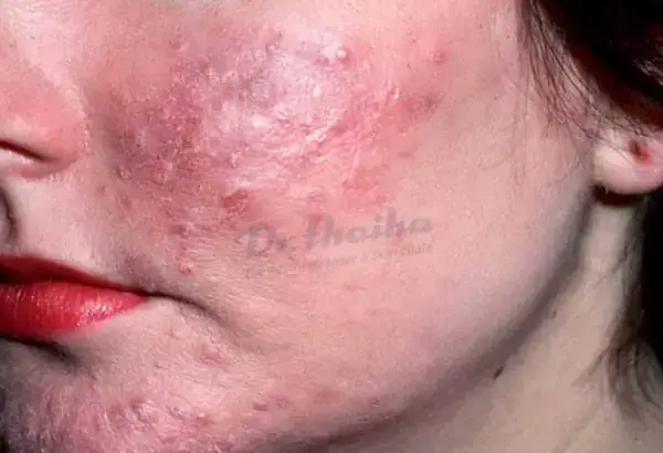 Hình Ảnh Trứng Cá Đỏ (rosacea): Dấu Hiệu, Nguyên Nhân & Cách Điều Trị